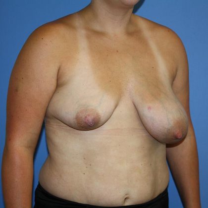 Breast Reconstruction Before & After Patient #5694