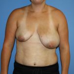 Breast Reconstruction Before & After Patient #5694