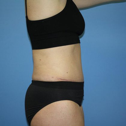 Tummy Tuck Before & After Patient #5717