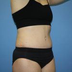 Tummy Tuck Before & After Patient #5717