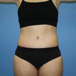 Tummy Tuck Before & After Patient #5717