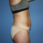 Tummy Tuck Before & After Patient #5717