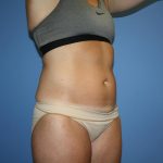 Tummy Tuck Before & After Patient #5717