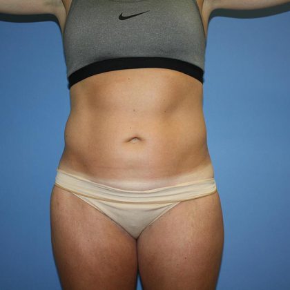 Tummy Tuck Before & After Patient #5717