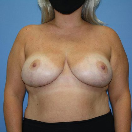 Breast Lift Before & After Patient #5718