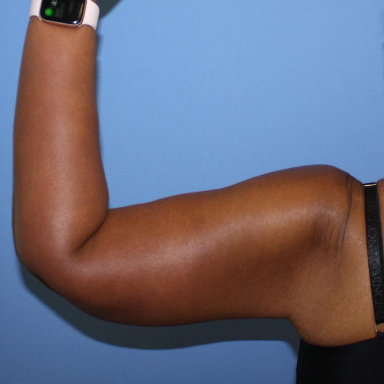 Arm Lift Before & After Patient #5719