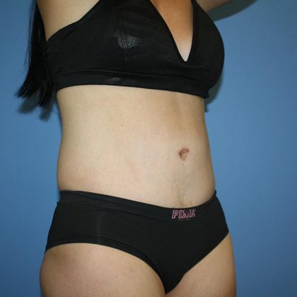 Tummy Tuck Before & After Patient #5720