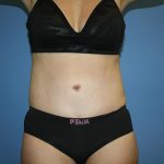 Tummy Tuck Before & After Patient #5720