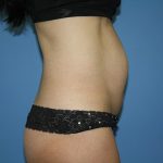 Tummy Tuck Before & After Patient #5720