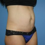 Tummy Tuck Before & After Patient #5720