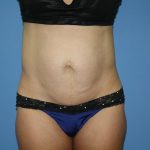 Tummy Tuck Before & After Patient #5720