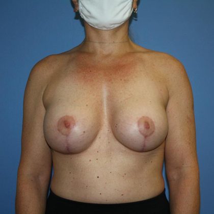 Breast Lift with Implant Before & After Patient #5721