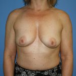 Breast Lift with Implant Before & After Patient #5721