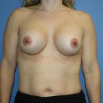 Breast Lift with Implant Before & After Patient #5738