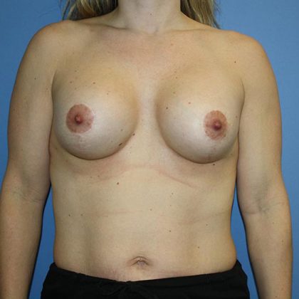 Breast Lift with Implant Before & After Patient #5738