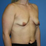 Breast Lift with Implant Before & After Patient #5738