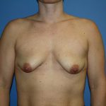 Breast Lift with Implant Before & After Patient #5738