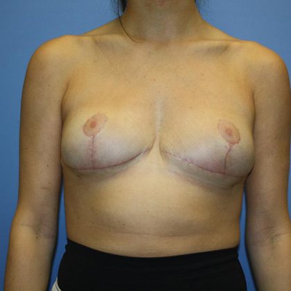 Breast Reconstruction Before & After Patient #5742