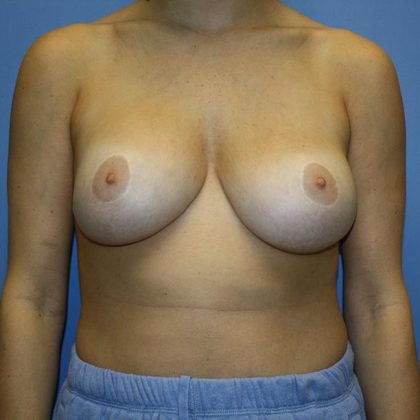Breast Reconstruction Before & After Patient #5742