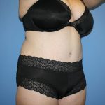 Tummy Tuck Before & After Patient #5743