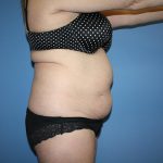 Tummy Tuck Before & After Patient #5743