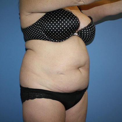 Tummy Tuck Before & After Patient #5743