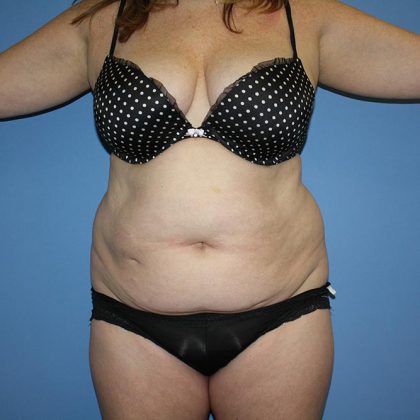 Tummy Tuck Before & After Patient #5743