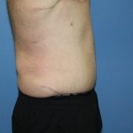 Tummy Tuck Before & After Patient #5620