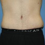 Tummy Tuck Before & After Patient #5620