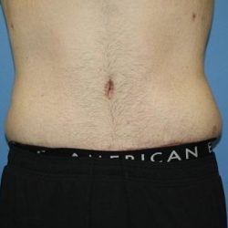 Tummy Tuck Before & After Patient #5620