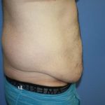 Tummy Tuck Before & After Patient #5620
