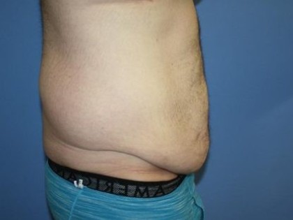 Tummy Tuck Before & After Patient #5620