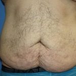 Tummy Tuck Before & After Patient #5620