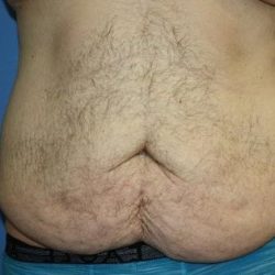 Tummy Tuck Before & After Patient #5620
