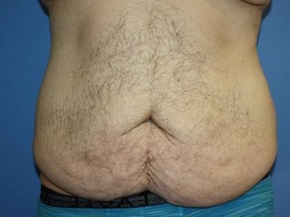 Tummy Tuck Before & After Patient #5620