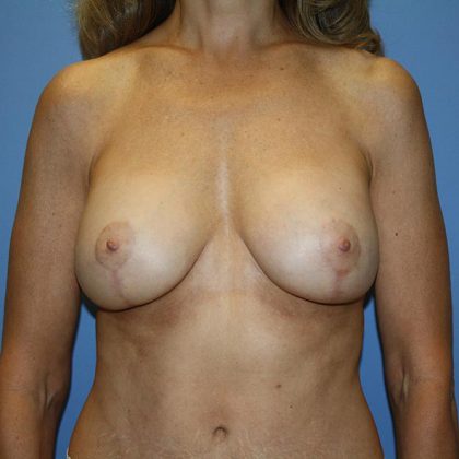 Breast Lift with Implant Before & After Patient #5757