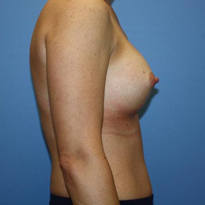 Breast Augmentation Before & After Patient #5758