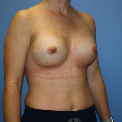 Breast Augmentation Before & After Patient #5758