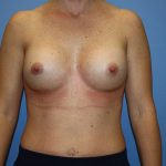 Breast Augmentation Before & After Patient #5758