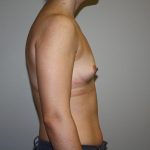 Breast Augmentation Before & After Patient #5758