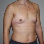 Breast Augmentation Before & After Patient #5758