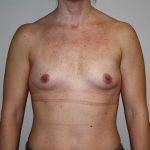 Breast Augmentation Before & After Patient #5758