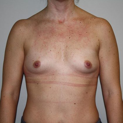 Breast Augmentation Before & After Patient #5758