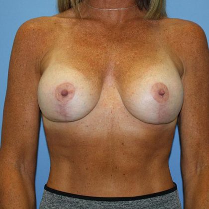 Breast Lift with Implant Before & After Patient #5760