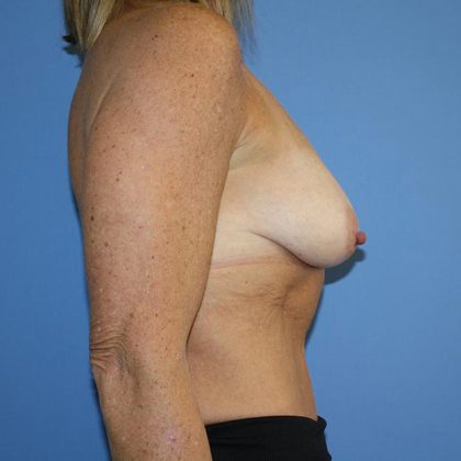 Breast Lift with Implant Before & After Patient #5760