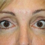 Eye Lid Lift Before & After Patient #5762