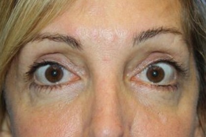 Eye Lid Lift Before & After Patient #5762