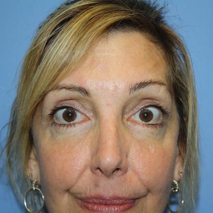 Eye Surgery Before & After Patient #5762