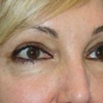 Eye Lid Lift Before & After Patient #5762