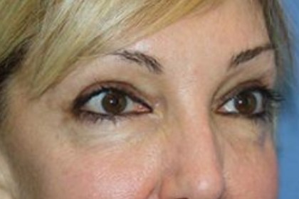 Eye Lid Lift Before & After Patient #5762